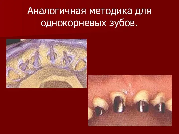 Аналогичная методика для однокорневых зубов.