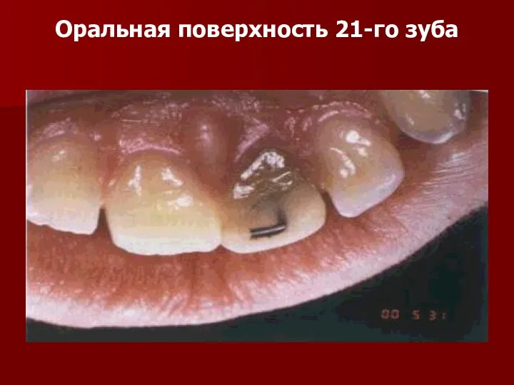 Оральная поверхность 21-го зуба