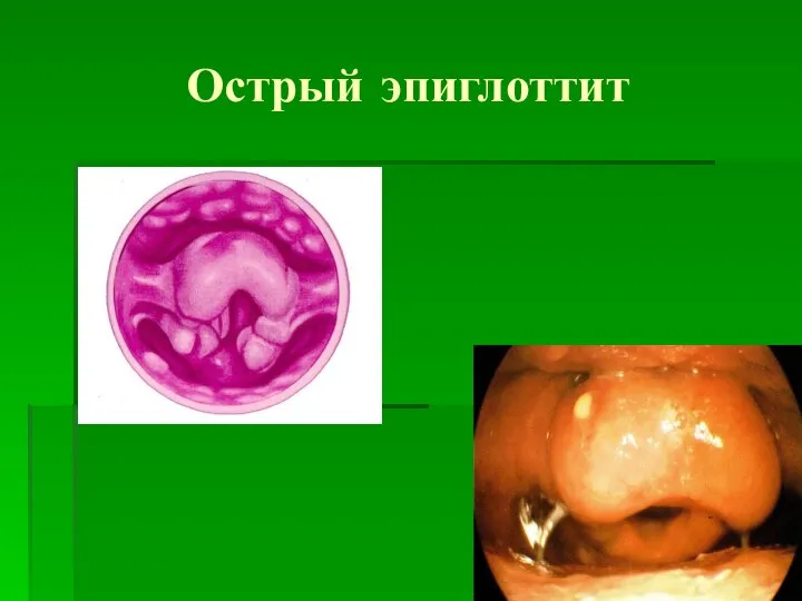 Острый эпиглоттит