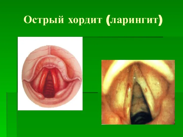 Острый хордит (ларингит)