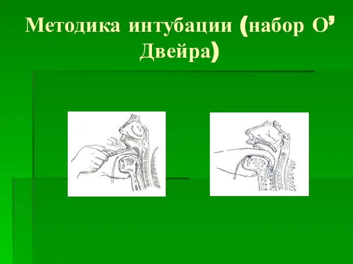 Методика интубации (набор О’Двейра)