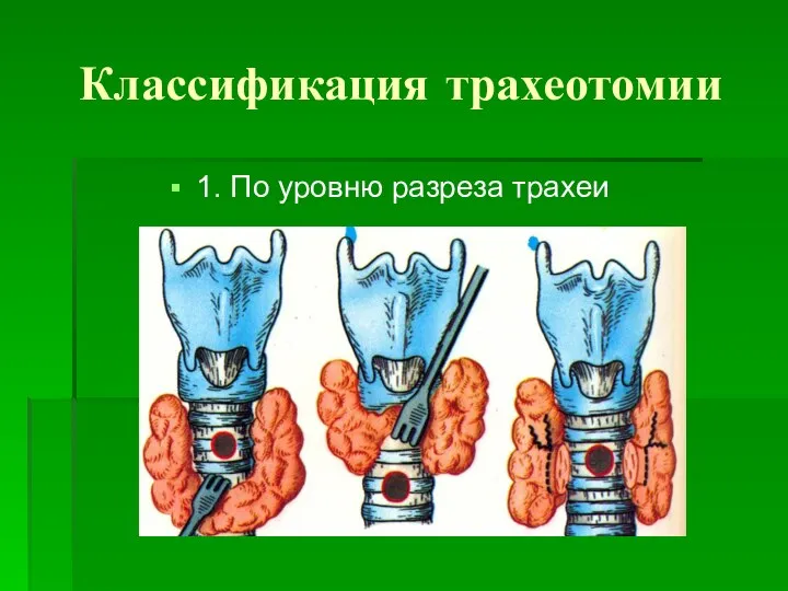 Классификация трахеотомии 1. По уровню разреза трахеи