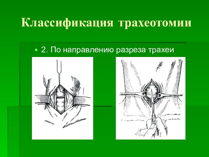 Классификация трахеотомии 2. По направлению разреза трахеи