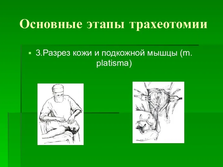 Основные этапы трахеотомии 3.Разрез кожи и подкожной мышцы (m. platisma)