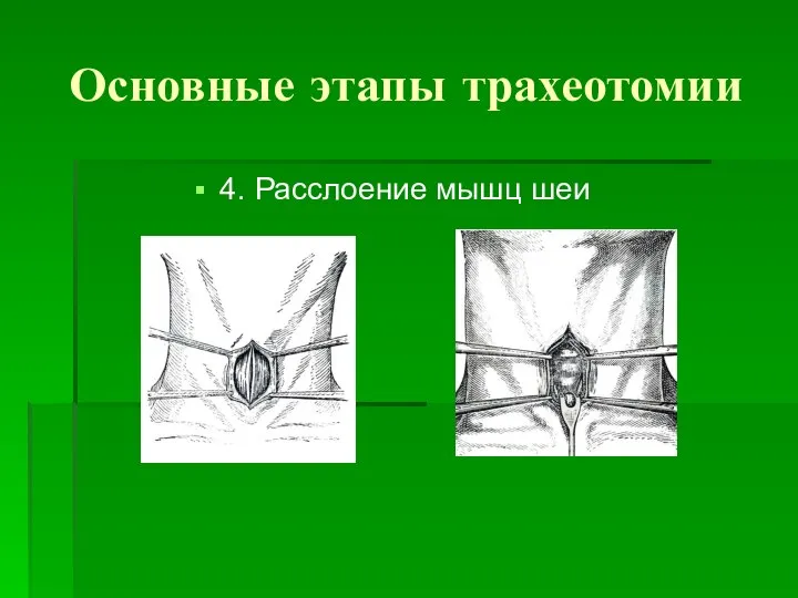 Основные этапы трахеотомии 4. Расслоение мышц шеи