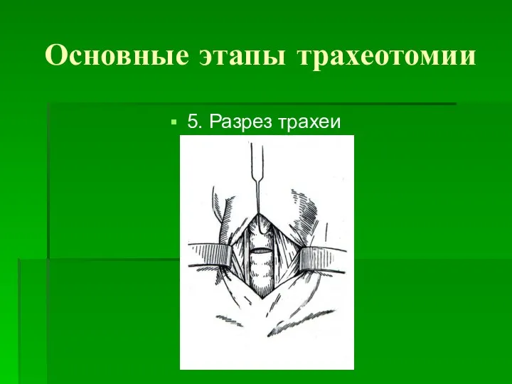 Основные этапы трахеотомии 5. Разрез трахеи