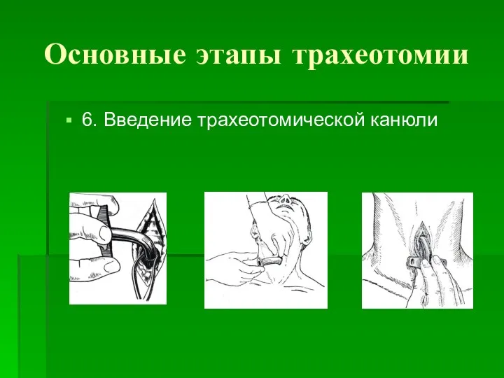 Основные этапы трахеотомии 6. Введение трахеотомической канюли