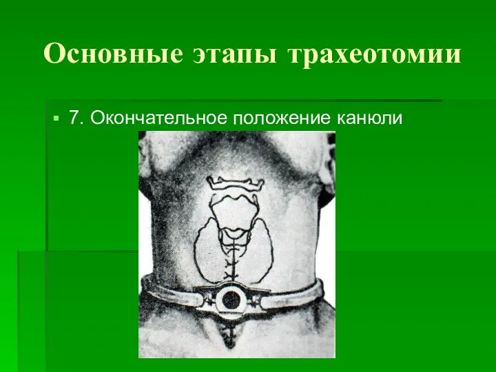 Основные этапы трахеотомии 7. Окончательное положение канюли