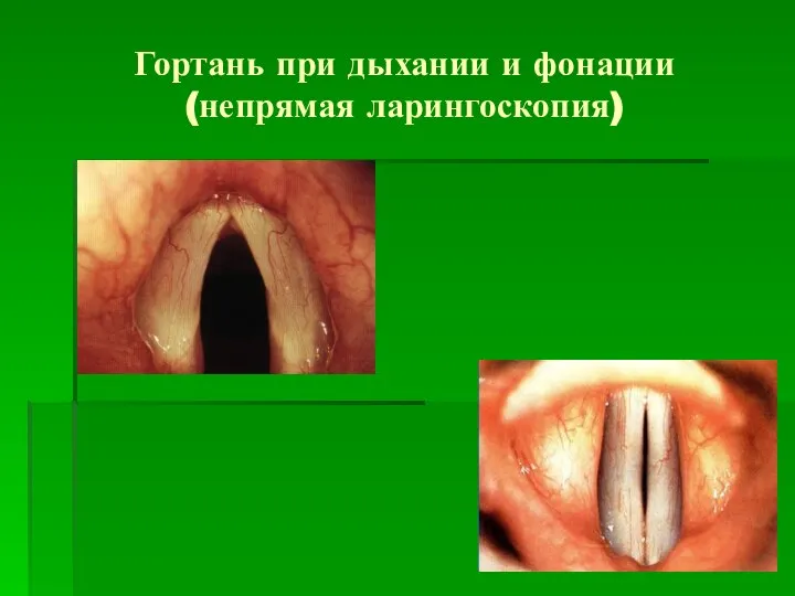 Гортань при дыхании и фонации (непрямая ларингоскопия)