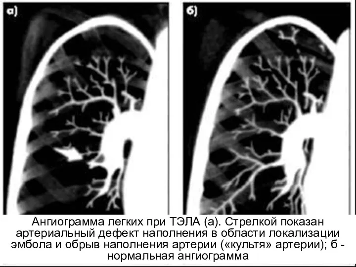 Ангиограмма легких при ТЭЛА (а). Стрелкой показан артериальный дефект наполнения в области