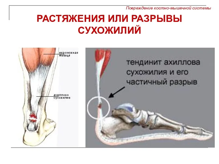 РАСТЯЖЕНИЯ ИЛИ РАЗРЫВЫ СУХОЖИЛИЙ