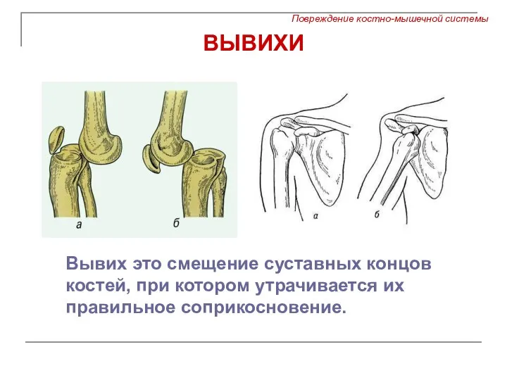 ВЫВИХИ Вывих это смещение суставных концов костей, при котором утрачивается их правильное соприкосновение.