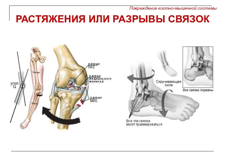 РАСТЯЖЕНИЯ ИЛИ РАЗРЫВЫ СВЯЗОК