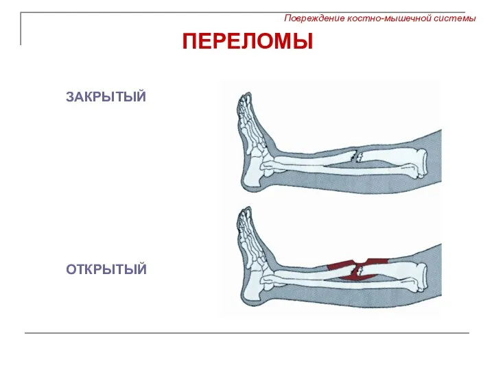 ПЕРЕЛОМЫ ЗАКРЫТЫЙ ОТКРЫТЫЙ