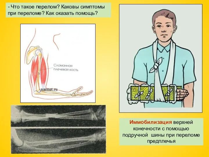 Иммобилизация верхней конечности с помощью подручной шины при переломе предплечья - Что