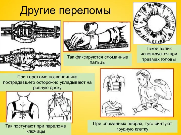 Другие переломы Такой валик используется при травмах головы Так фиксируются сломанные пальцы