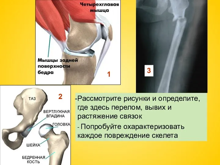 1 2 Рассмотрите рисунки и определите, где здесь перелом, вывих и растяжение