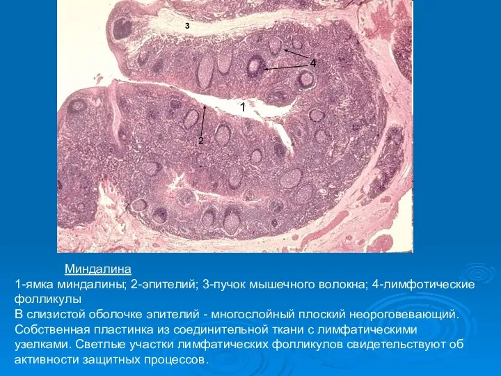 Миндалина 1-ямка миндалины; 2-эпителий; 3-пучок мышечного волокна; 4-лимфотические фолликулы В слизистой оболочке