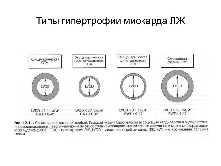 Типы гипертрофии миокарда ЛЖ