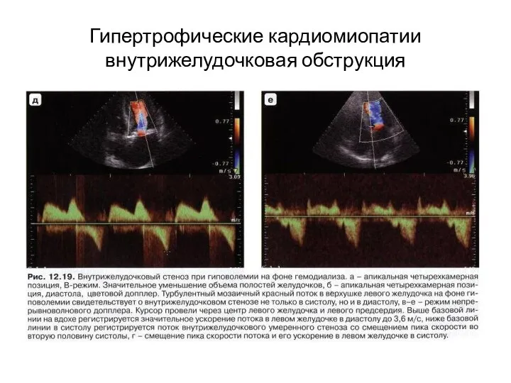 Гипертрофические кардиомиопатии внутрижелудочковая обструкция