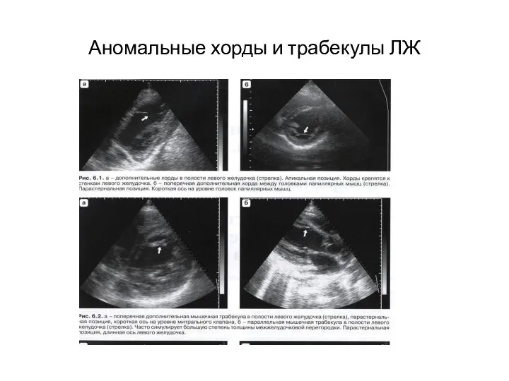 Аномальные хорды и трабекулы ЛЖ