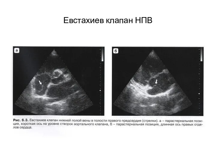 Евстахиев клапан НПВ