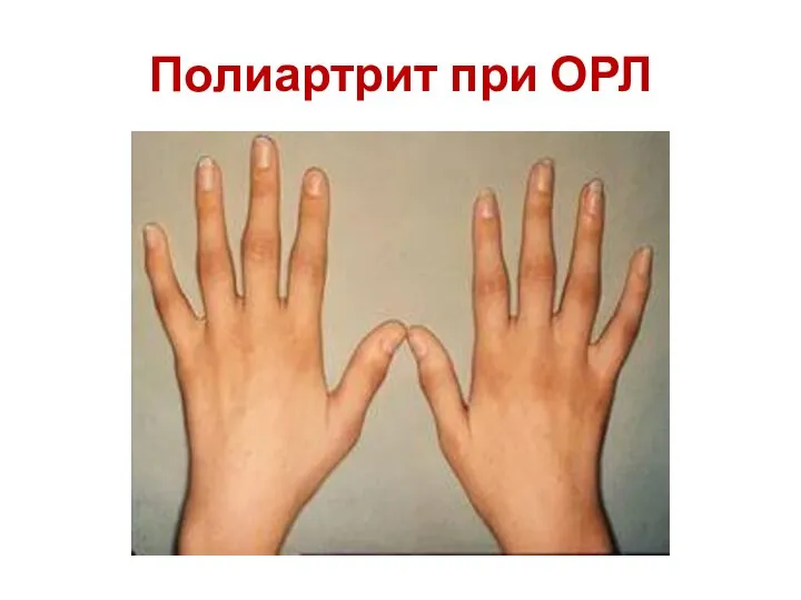 Полиартрит при ОРЛ