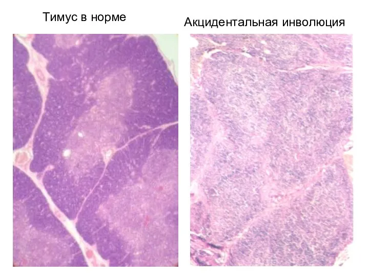 Акцидентальная инволюция Тимус в норме