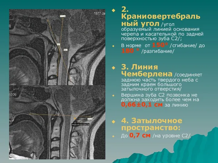 2. Краниовертебральный угол /угол образуемый линией основания черепа и касательной по задней