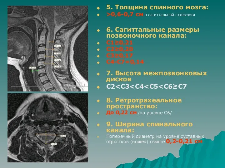 5. Толщина спинного мозга: >0,6-0,7 см в сагиттальной плоскости 6. Сагиттальные размеры