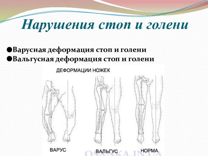 Нарушения стоп и голени Варусная деформация стоп и голени Вальгусная деформация стоп и голени