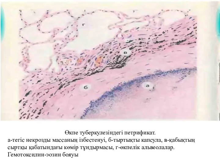 Өкпе туберкулезіндегі петрификат. а-тегіс некрозды массаның ізбестенуі, б-тыртықты капсула, в-қабықтың сыртқы қабатындағы