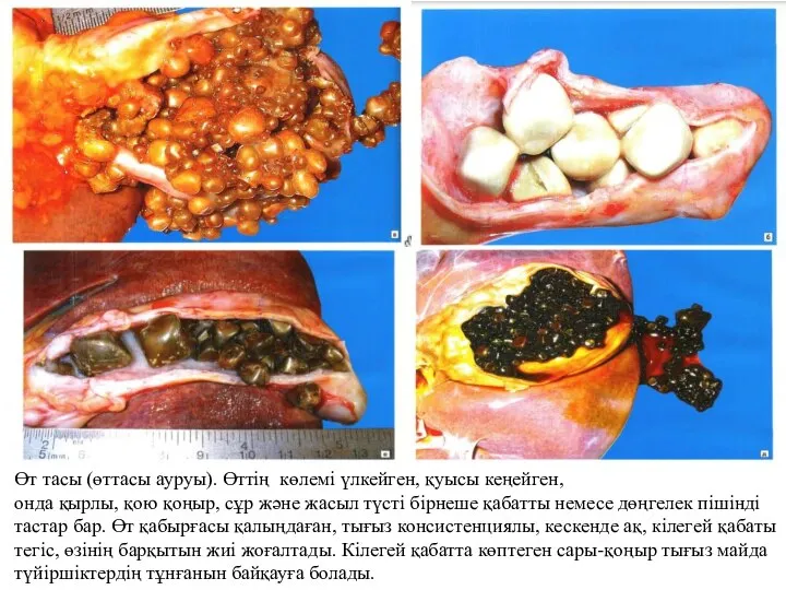 Өт тасы (өттасы ауруы). Өттің көлемі үлкейген, қуысы кеңейген, онда қырлы, қою