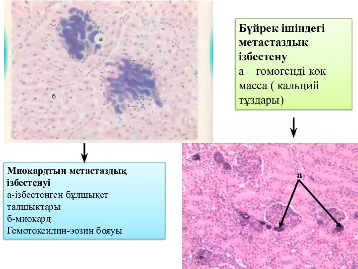 Миокардтың метастаздық ізбестенуі а-ізбестенген бұлшықет талшықтары б-миокард Гемотоксилин-эозин бояуы Бүйрек ішіндегі метастаздық