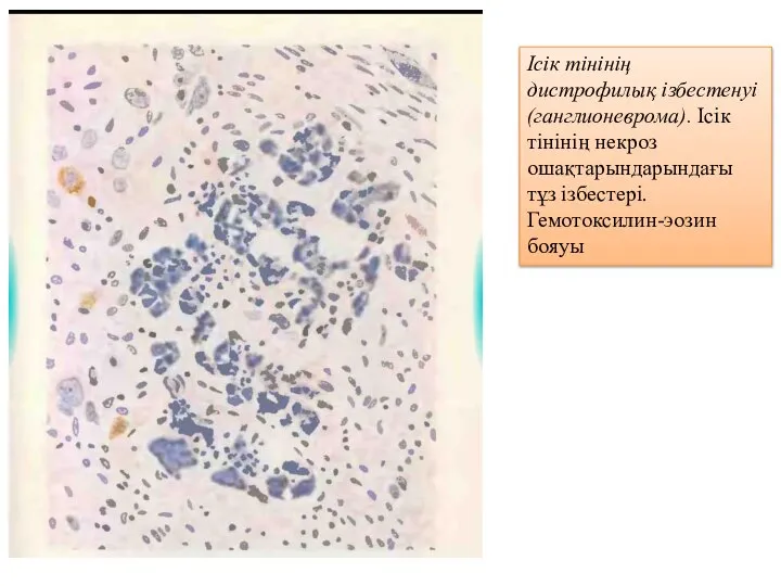 Ісік тінінің дистрофилық ізбестенуі (ганглионеврома). Ісік тінінің некроз ошақтарындарындағы тұз ізбестері. Гемотоксилин-эозин бояуы