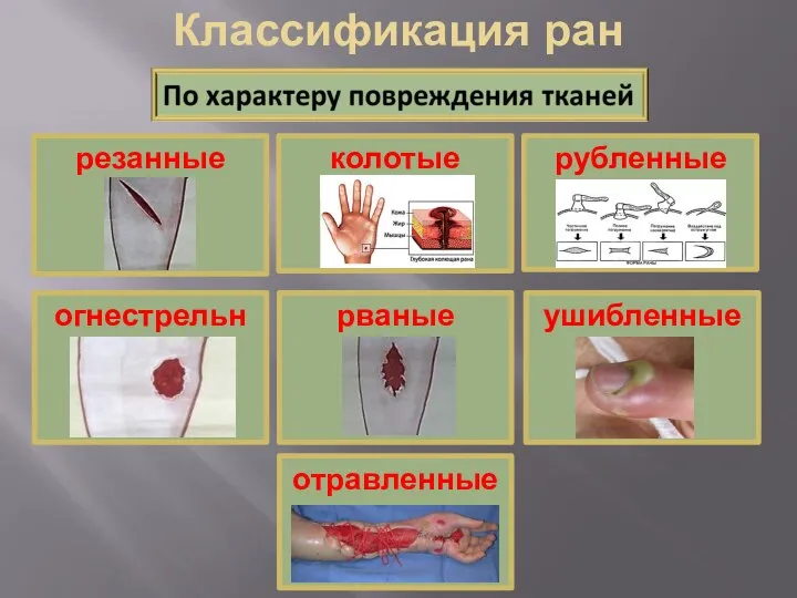 Классификация ран резанные рубленные колотые ушибленные рваные отравленные огнестрельные