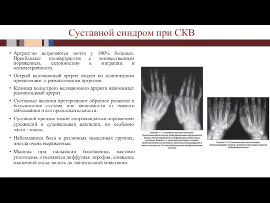 Артралгии встречаются почти у 100% больных. Преобладает полиартралгия с множественным поражением, склонностью