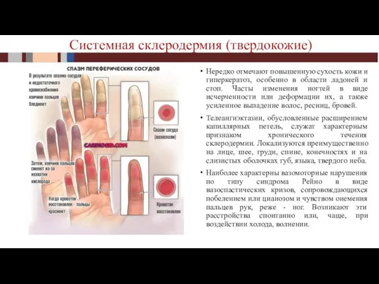 Нередко отмечают повышенную сухость кожи и гиперкератоз, особенно в области ладоней и