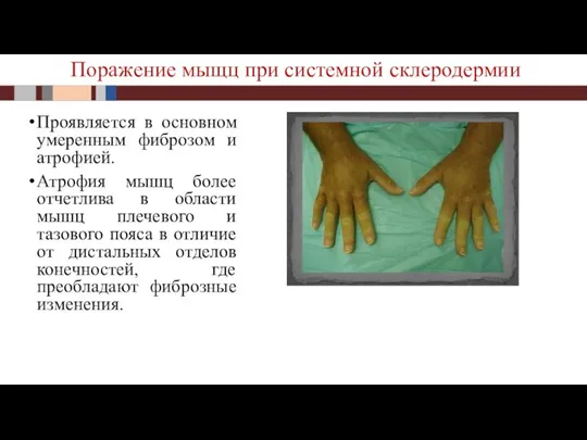 Проявляется в основном умеренным фиброзом и атрофией. Атрофия мышц более отчетлива в