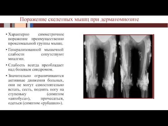 Характерно симметричное поражение преимущественно проксимальной группы мышц. Генерализованной мышечной слабости сопутствуют миалгии.