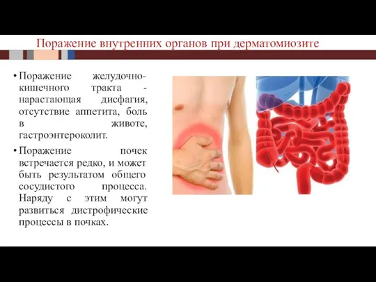 Поражение желудочно-кишечного тракта - нарастающая дисфагия, отсутствие аппетита, боль в животе, гастроэнтероколит.