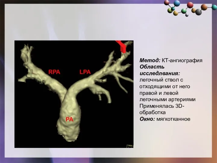 Метод: КТ-ангиография Область исследлвания: легочный ствол с отходящими от него правой и