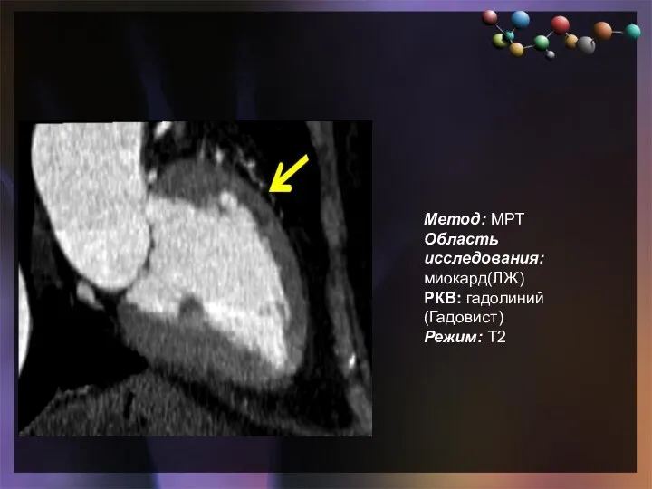 Подзаголовок слайда Метод: МРТ Область исследования: миокард(ЛЖ) РКВ: гадолиний(Гадовист) Режим: Т2