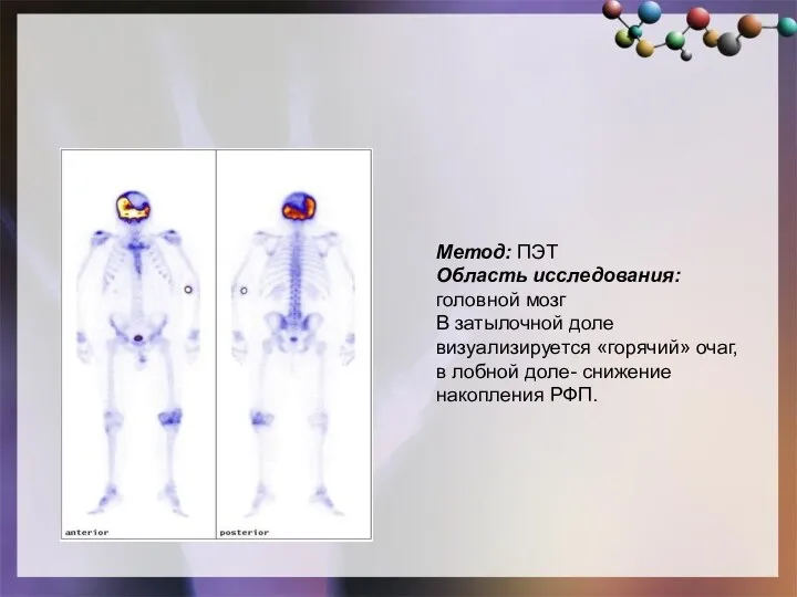 Метод: ПЭТ Область исследования: головной мозг В затылочной доле визуализируется «горячий» очаг,