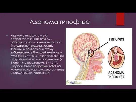 Аденома гипофиза Аденома гипофиза – это доброкачественная опухоль, образующаяся из клеток гипофиза