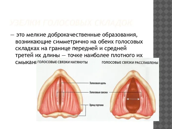 УЗЕЛКИ ГОЛОСОВЫХ СКЛАДОК — это мелкие доброкачественные образования, возникающие симметрично на обеих