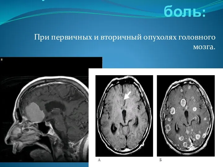 Хроническая головная боль: При первичных и вторичный опухолях головного мозга.