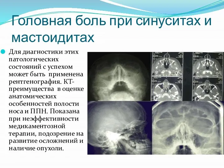 Головная боль при синуситах и мастоидитах Для диагностики этих патологических состояний с