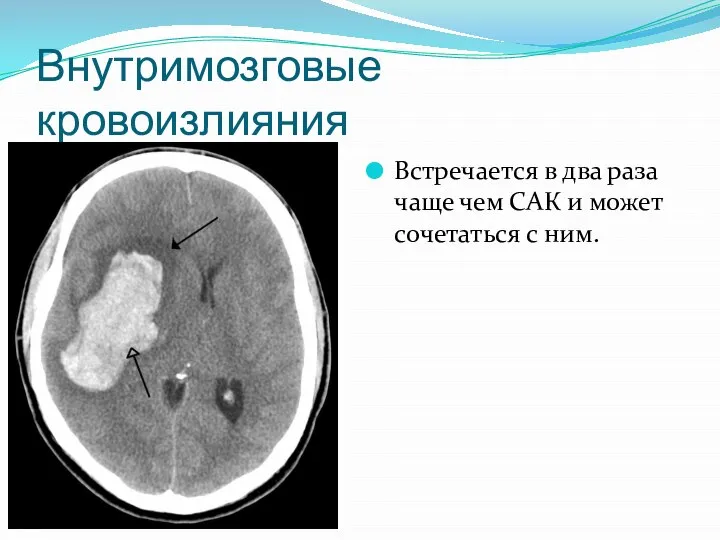 Внутримозговые кровоизлияния Встречается в два раза чаще чем САК и может сочетаться с ним.