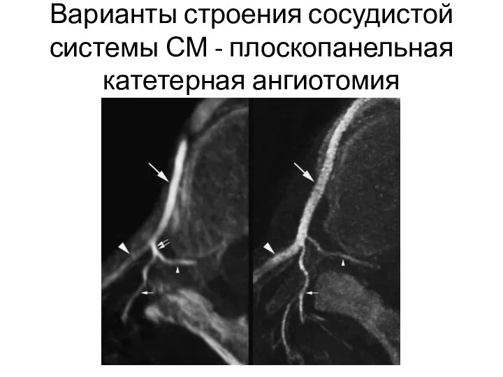 Варианты строения сосудистой системы СМ - плоскопанельная катетерная ангиотомия